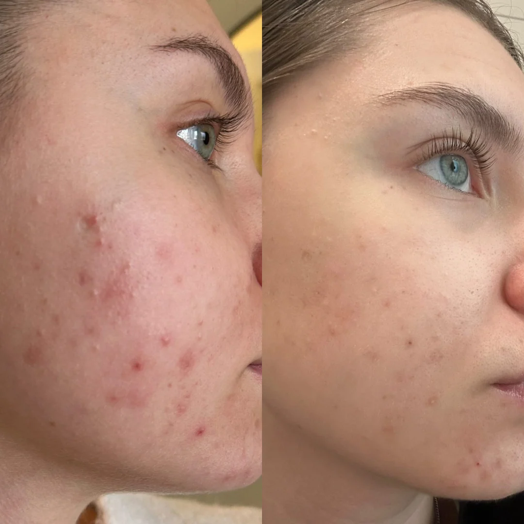 Acne Gone, But Dark Spots Remain? Expert Treatment for Post-Acne Pigmentation in Navi Mumbai!